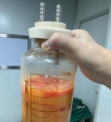 孝感水动力吸脂手术要做多久？